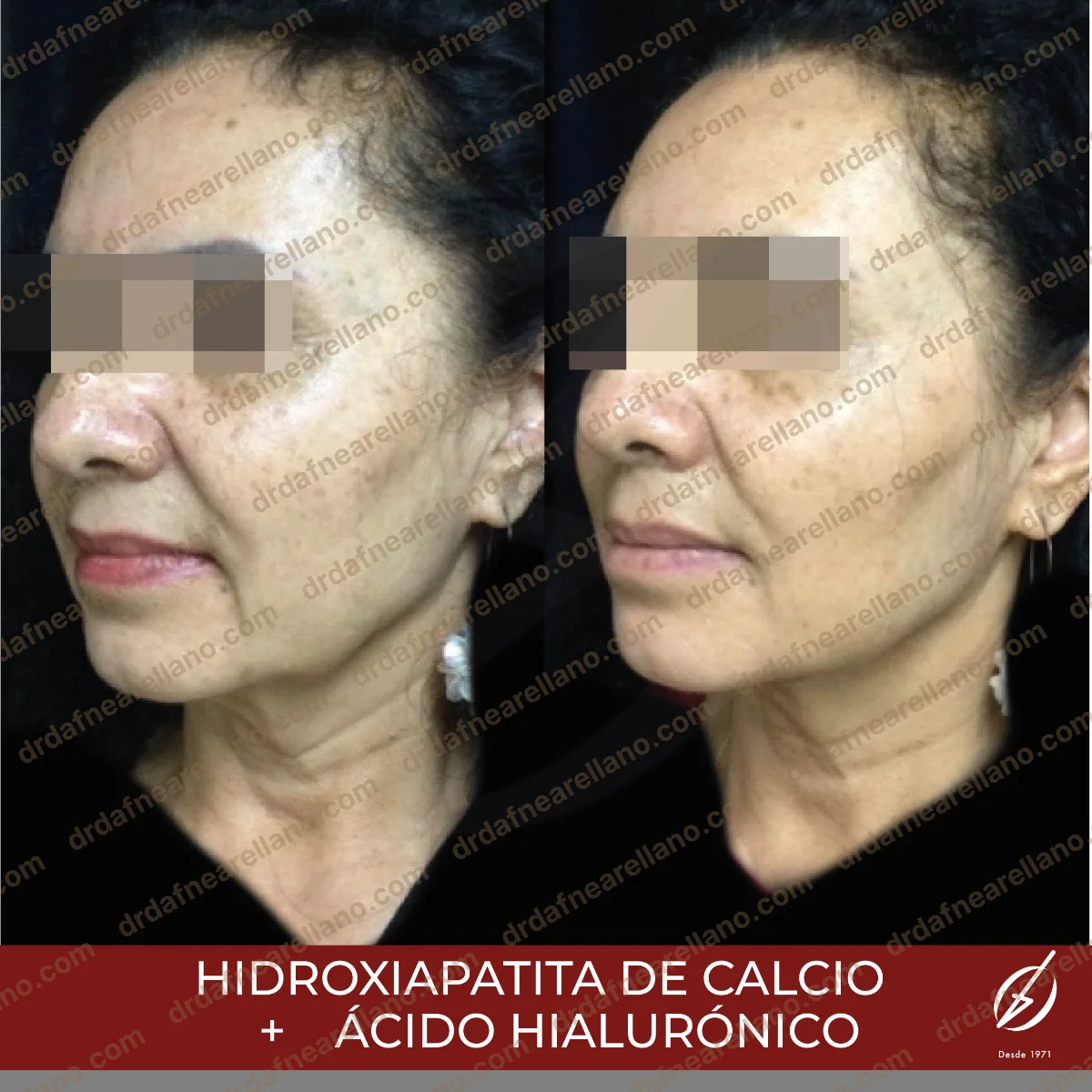 Resultado tras aplicación de ácido hialurónico — comparativo antes y después
