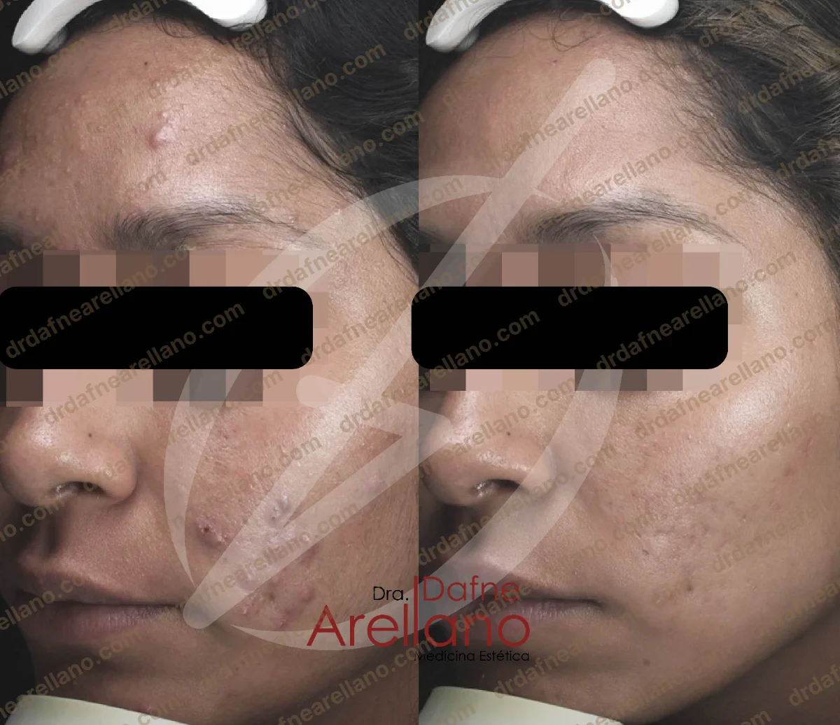 Antes y después — Tratamiento de Acné en Puebla
