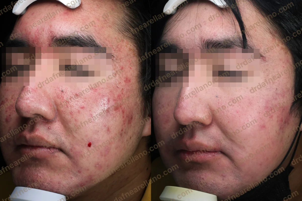 Antes y después — Tratamiento de Acné en Puebla
