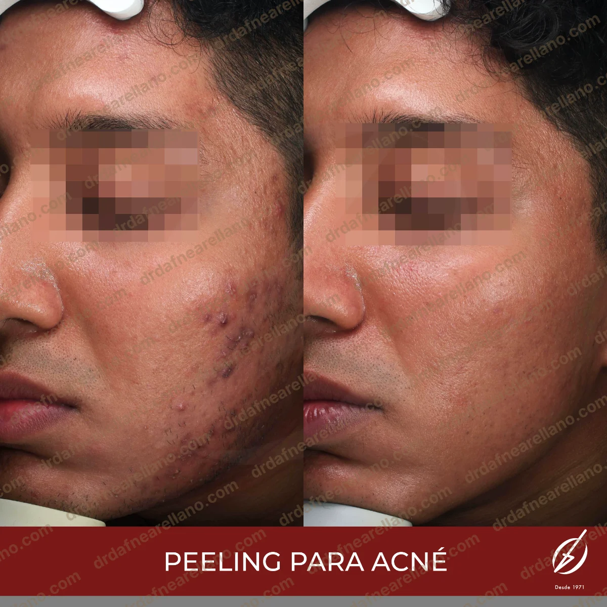 Antes y después — Acné en Puebla