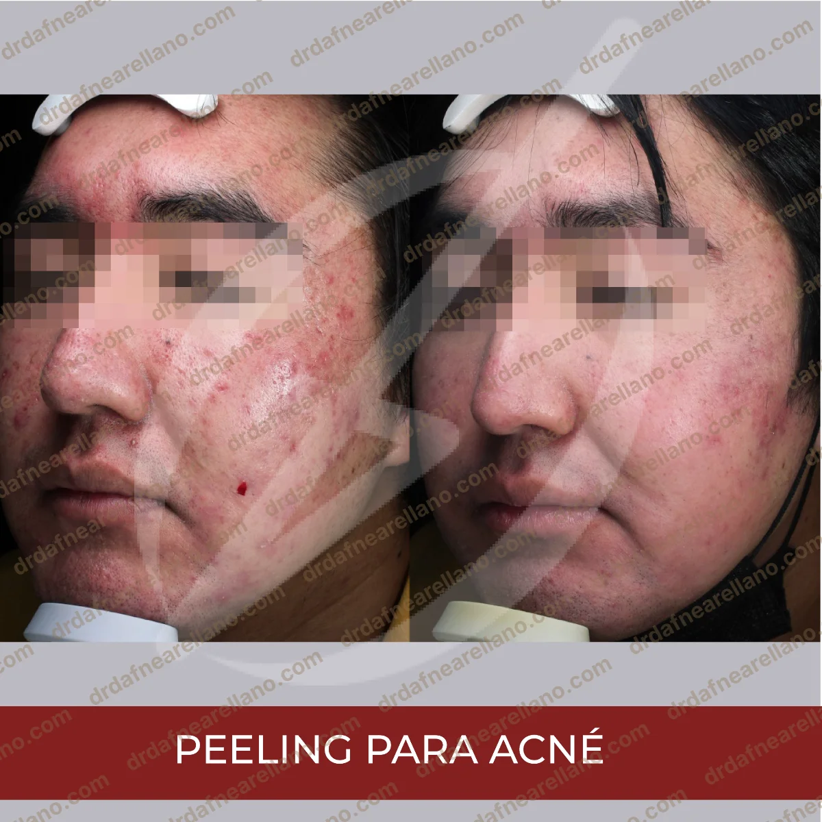 Antes y después — Acné en Puebla