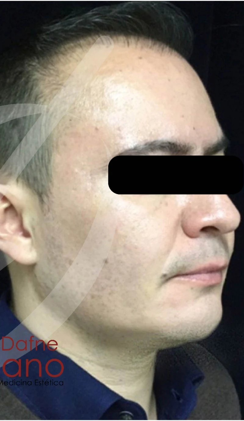 Paciente masculino. Perfilado mandibular y definición del tercio inferior con ácido hialurónico premium para recuperar contorno y proyección angular natural. Resultado evaluado en valoración personalizada con la Dra. Dafne Arellano (Cédula 9048813).