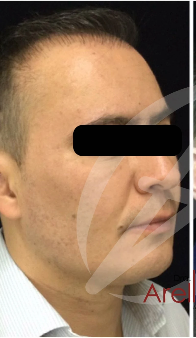 Paciente masculino. Perfilado mandibular y definición del tercio inferior con ácido hialurónico premium para recuperar contorno y proyección angular natural. Resultado evaluado en valoración personalizada con la Dra. Dafne Arellano (Cédula 9048813).