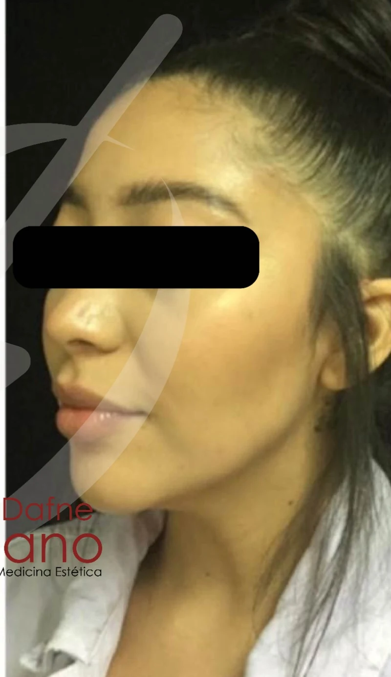 Paciente femenina joven. Armonización facial con ácido hialurónico en pómulos y contorno mandibular para mejorar simetría y definición sin perder naturalidad. Resultado bajo valoración médica personalizada.