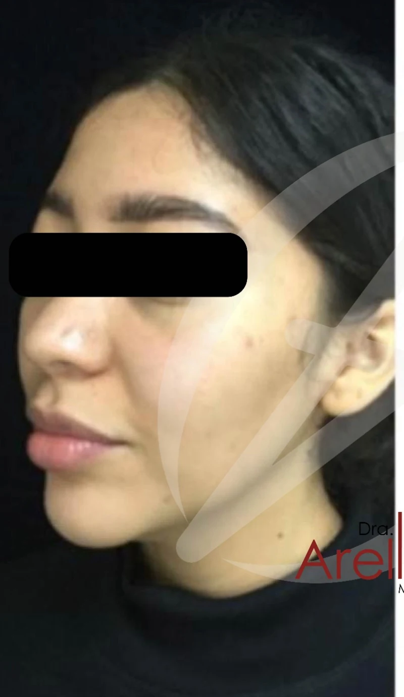 Paciente femenina joven. Armonización facial con ácido hialurónico en pómulos y contorno mandibular para mejorar simetría y definición sin perder naturalidad. Resultado bajo valoración médica personalizada.