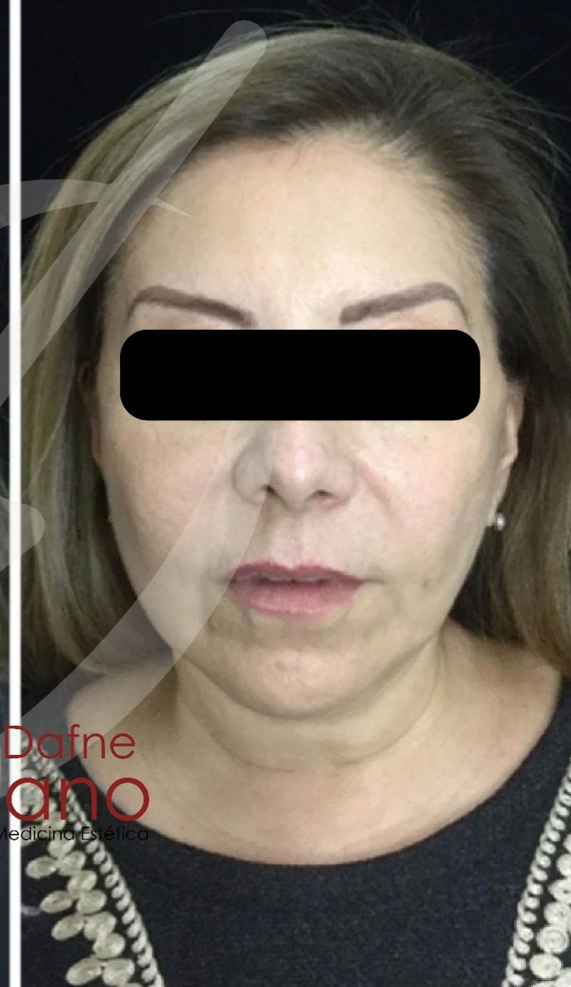 Paciente femenina madura. Armonización integral con bioestimuladores y ácido hialurónico estratégico en tercio medio e inferior. Restauración de volumen facial perdido por edad con apariencia descansada y natural.