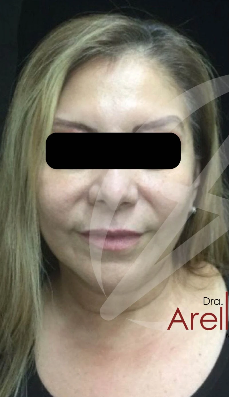 Paciente femenina madura. Armonización integral con bioestimuladores y ácido hialurónico estratégico en tercio medio e inferior. Restauración de volumen facial perdido por edad con apariencia descansada y natural.