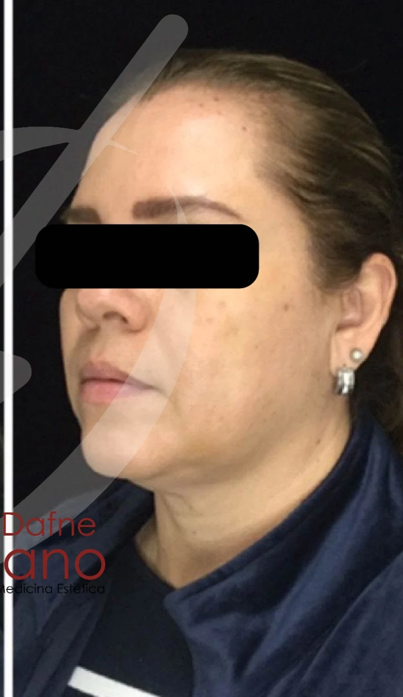 Paciente femenina. Armonización facial completa con ácido hialurónico premium y bioestimuladores. Definición de pómulos, contorno mandibular y rejuvenecimiento integral del tercio inferior bajo valoración personalizada.