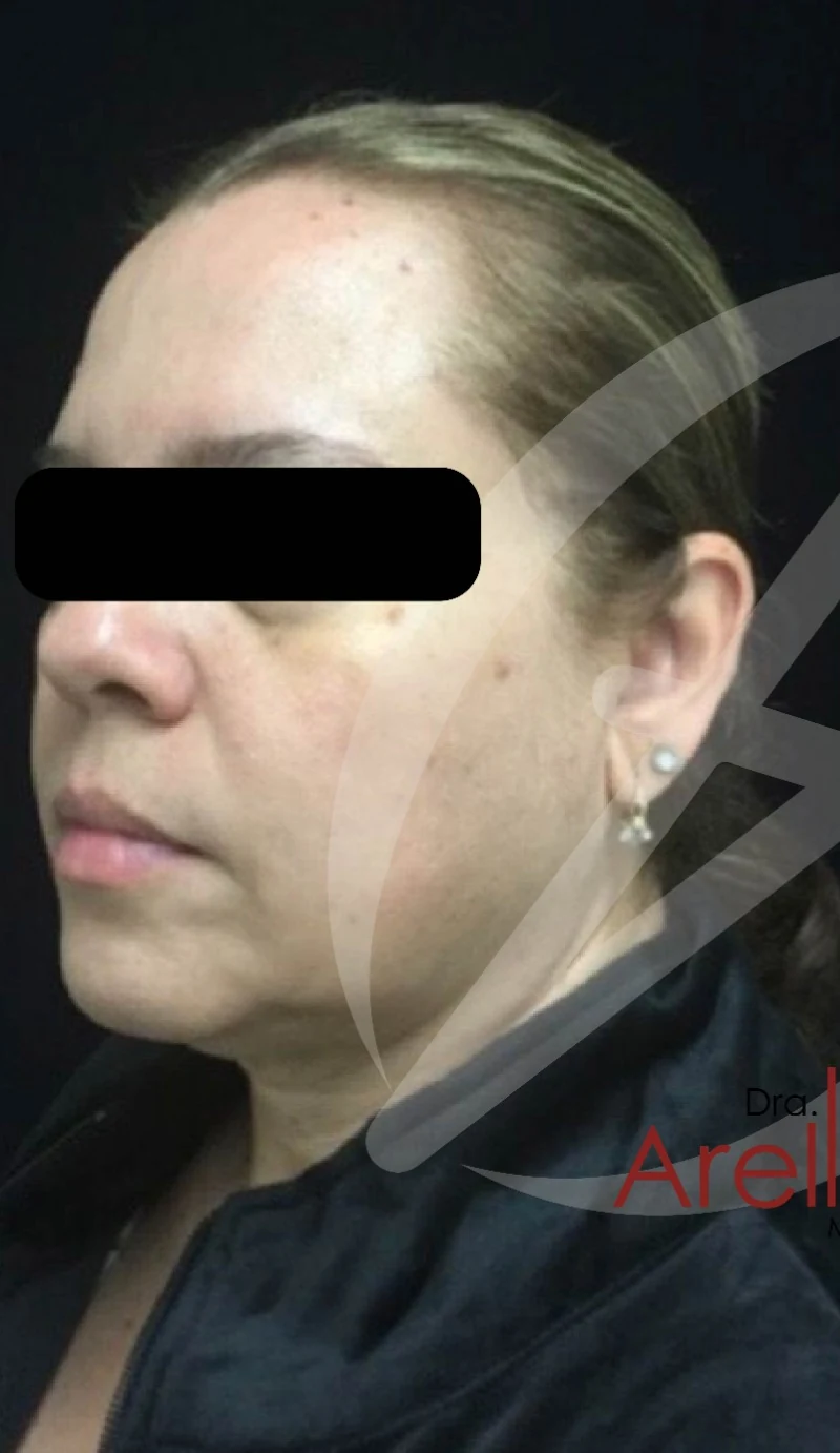 Paciente femenina. Armonización facial completa con ácido hialurónico premium y bioestimuladores. Definición de pómulos, contorno mandibular y rejuvenecimiento integral del tercio inferior bajo valoración personalizada.
