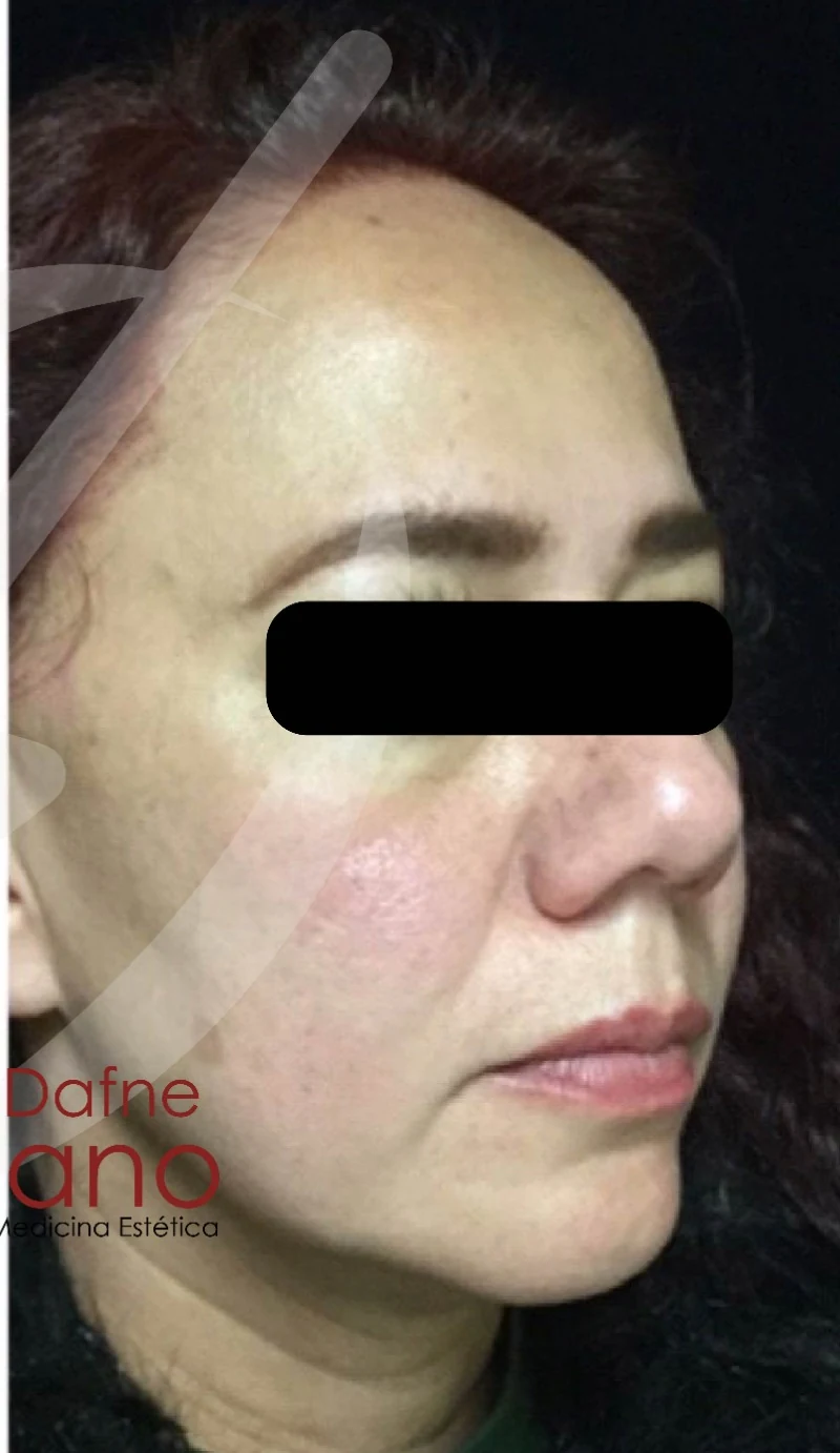 Paciente femenina. Armonización facial estratégica con ácido hialurónico en zona peri-orbital, pómulos y mentón. Mejor luminosidad y descanso facial sin alterar expresión natural. Resultado evaluado bajo valoración médica.