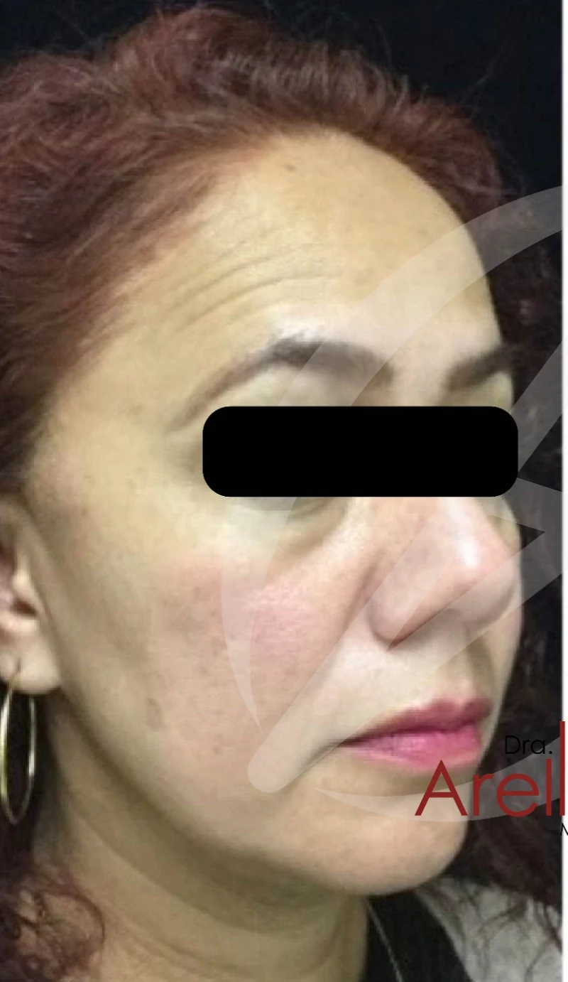 Paciente femenina. Armonización facial estratégica con ácido hialurónico en zona peri-orbital, pómulos y mentón. Mejor luminosidad y descanso facial sin alterar expresión natural. Resultado evaluado bajo valoración médica.
