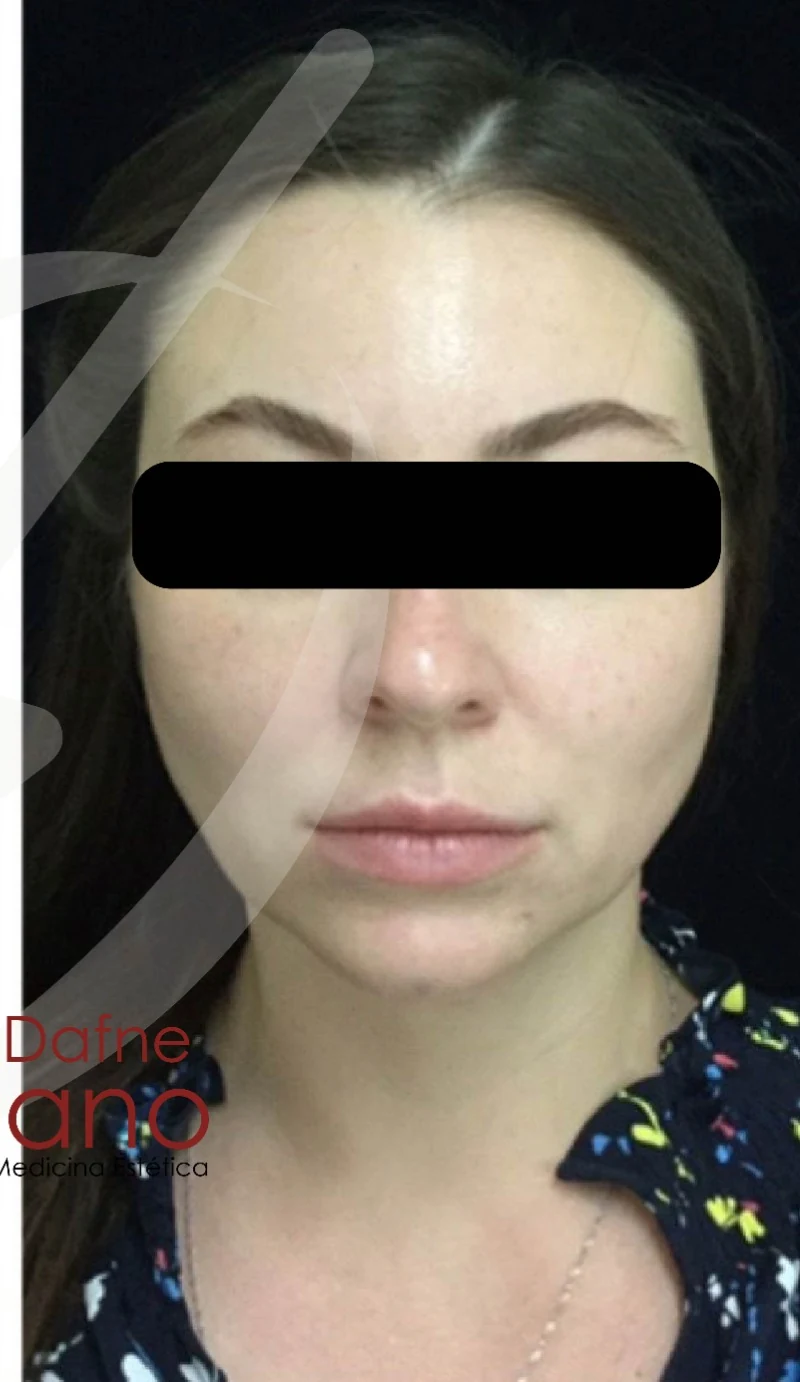 Paciente femenina. Armonización facial integral con definición mandibular, pómulos y mentón usando ácido hialurónico de marcas premium reversibles (Juvéderm, Restylane, Teoxane). Resultado natural bajo valoración personalizada Dra. Dafne Arellano.