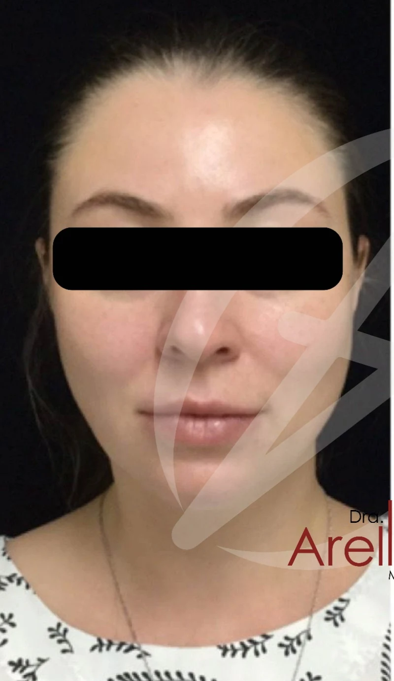 Paciente femenina. Armonización facial integral con definición mandibular, pómulos y mentón usando ácido hialurónico de marcas premium reversibles (Juvéderm, Restylane, Teoxane). Resultado natural bajo valoración personalizada Dra. Dafne Arellano.