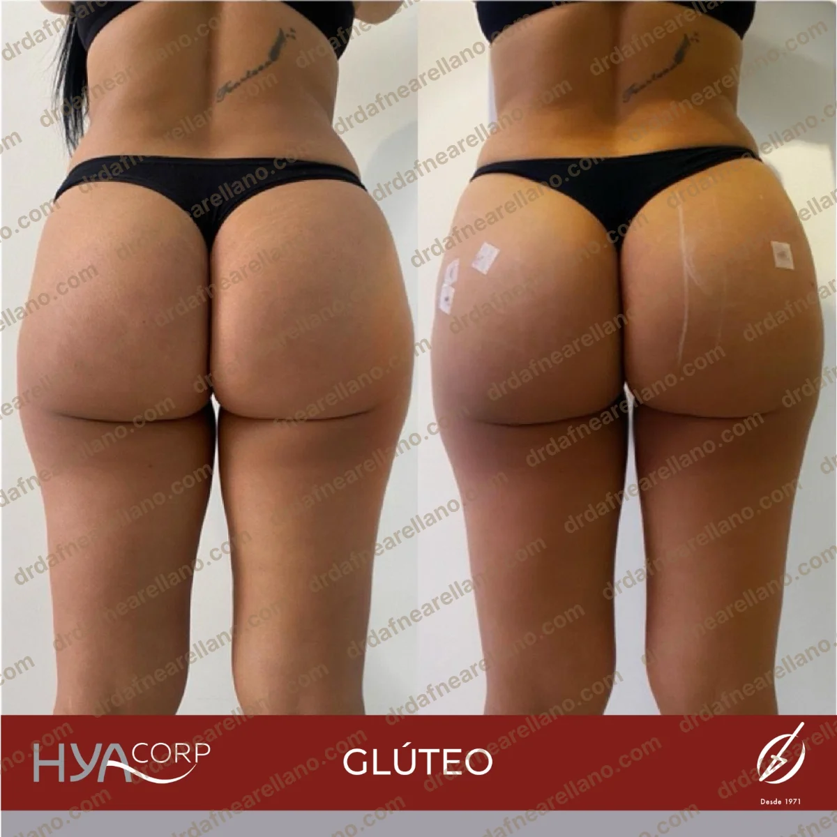 Antes y después — Aumento Glúteos sin Cirugía en Puebla