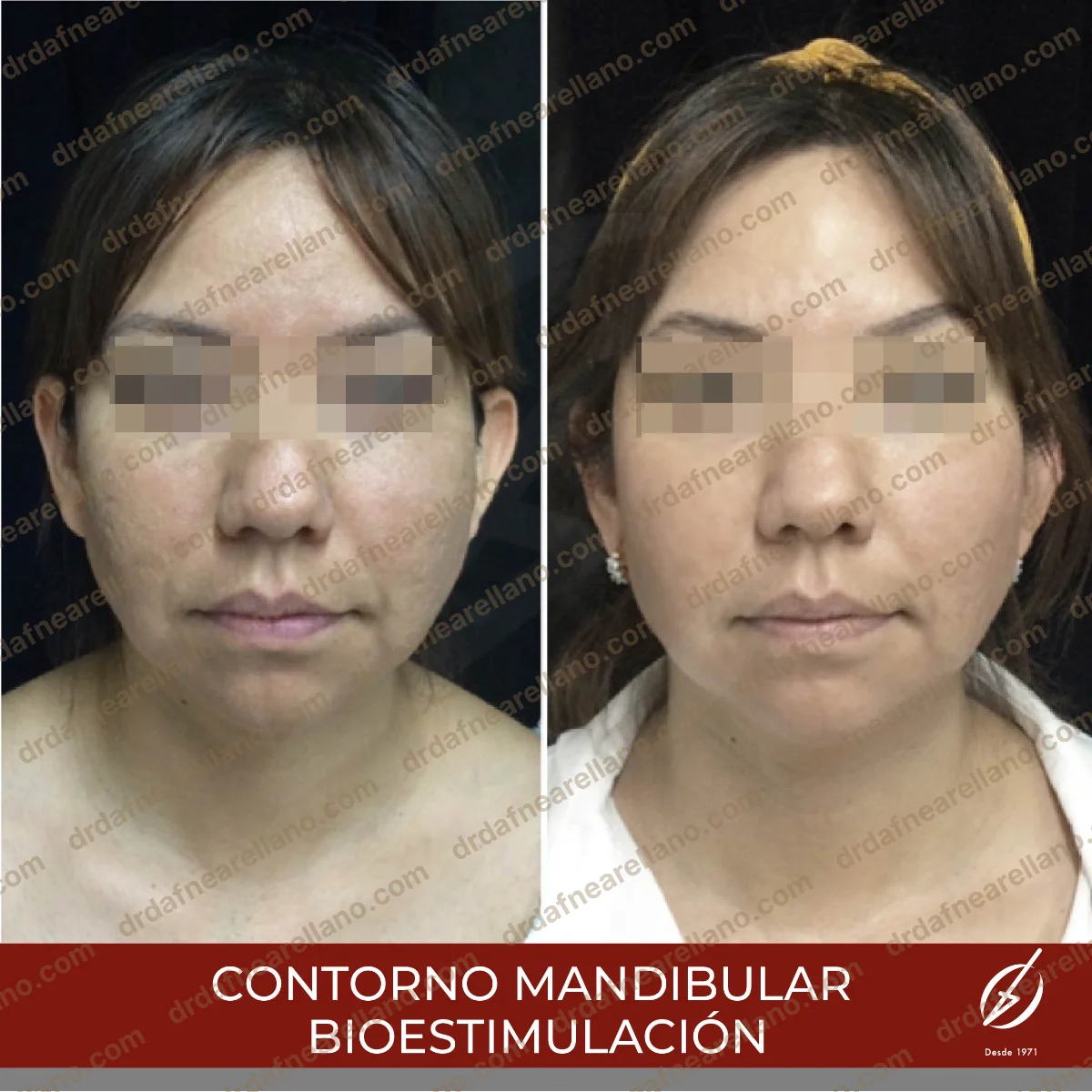 Antes y después — Bioestimuladores en Puebla
