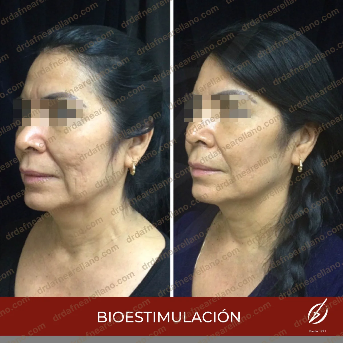 Antes y después — Bioestimuladores en Puebla