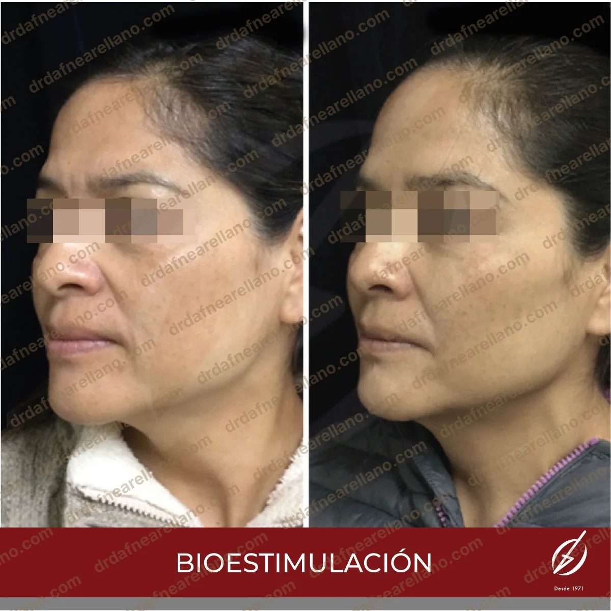 Antes y después — Bioestimuladores en Puebla