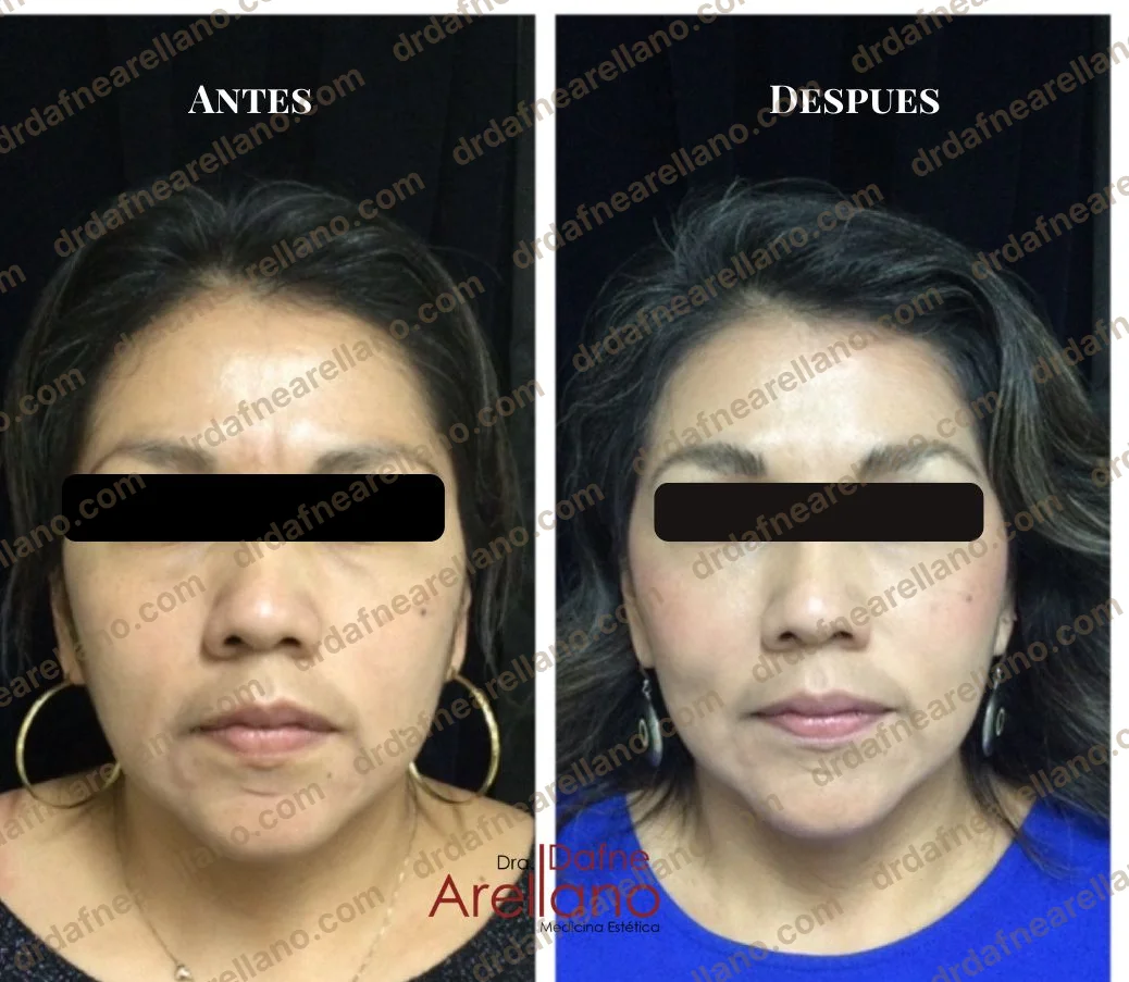 Antes y después — Bioestimuladores en Puebla