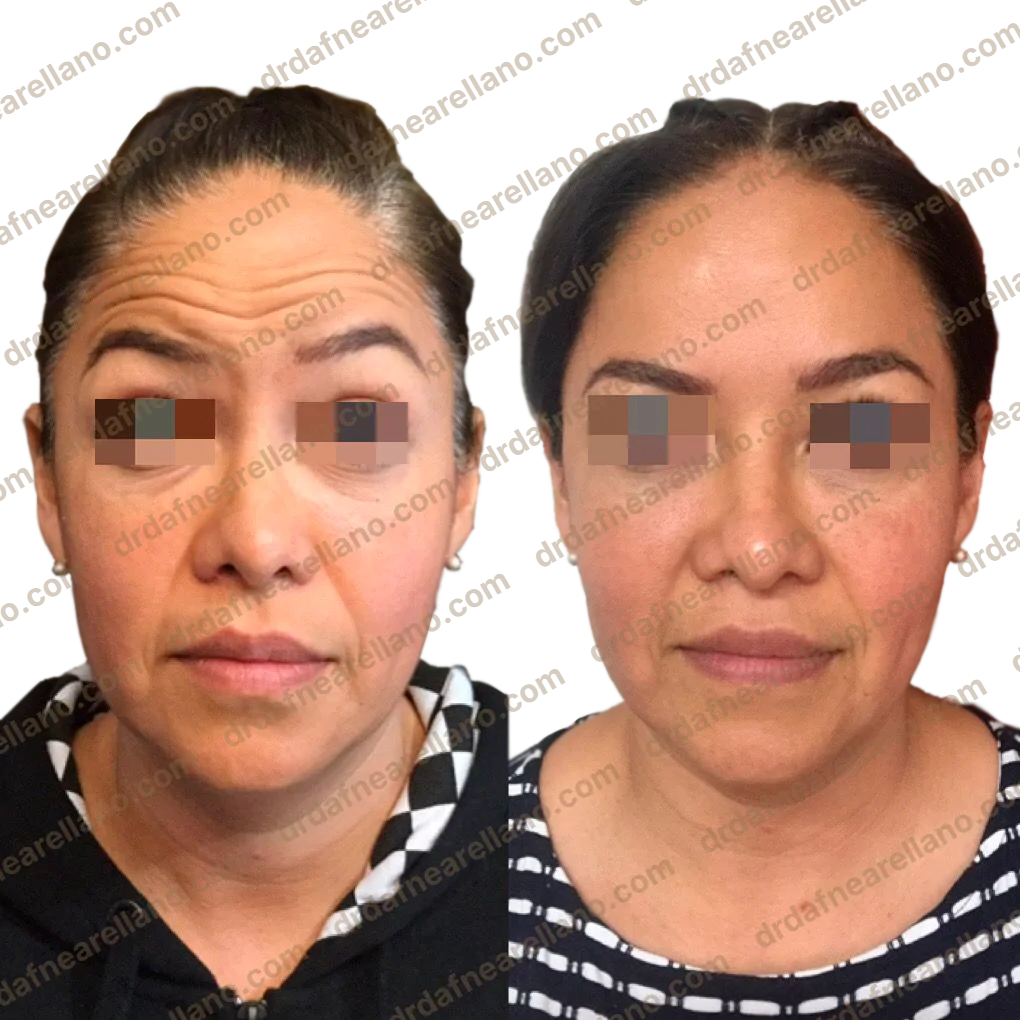 Antes y después — Botox en Puebla – Toxina Botulínica con Resultados Naturales