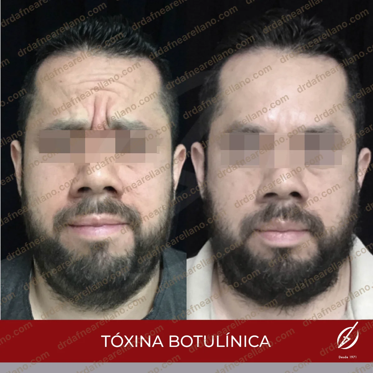 Antes y después — Botox en Puebla – Toxina Botulínica con Resultados Naturales