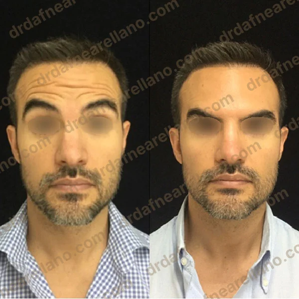 Antes y después — Botox en Puebla – Toxina Botulínica con Resultados Naturales