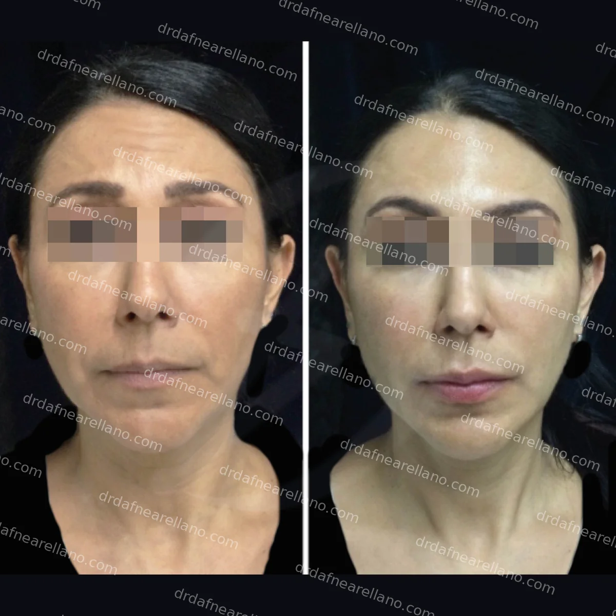 Botox (toxina botulinica) y relleno de labios con acido hialuronico en Puebla — resultado antes y despues. Tratamiento realizado por la Dra. Dafne Arellano Montalvo, Cedula Profesional 9048813, Clinica en Bella Vista, Puebla. Julio 2026.