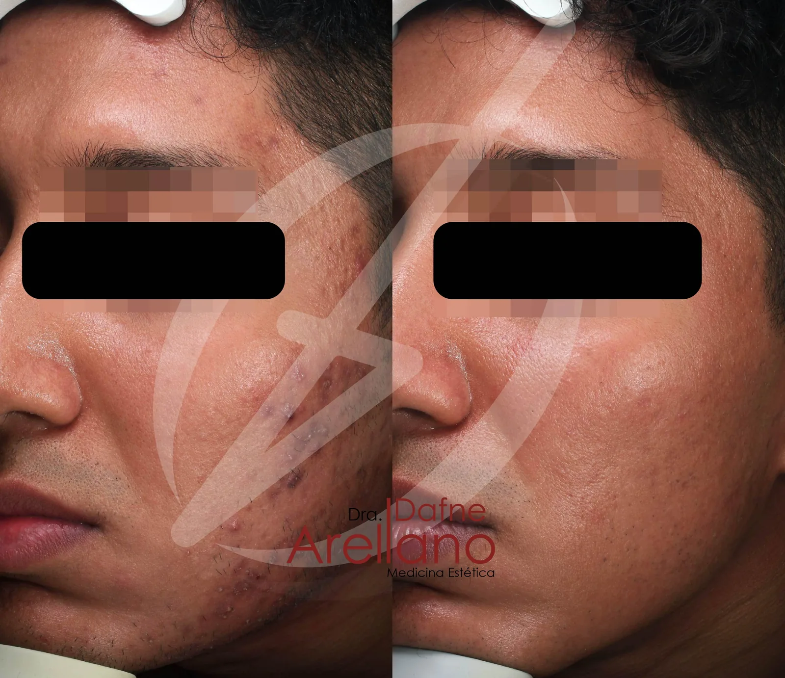 Después — Tratamiento de Cicatrices de Acné en Puebla
