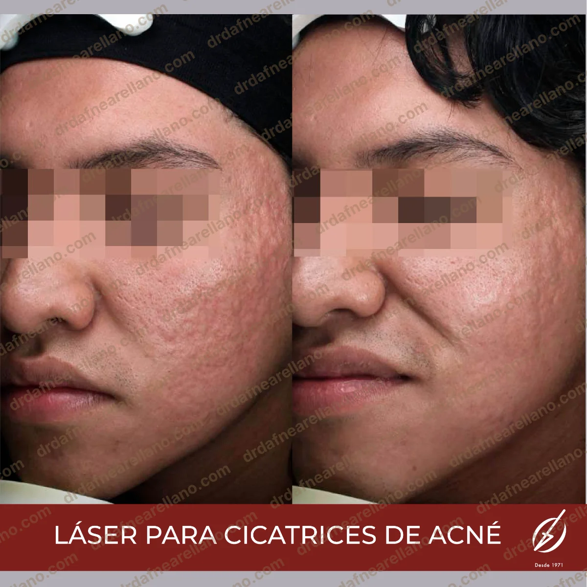 Antes y después — Tratamiento de Cicatrices de Acné en Puebla