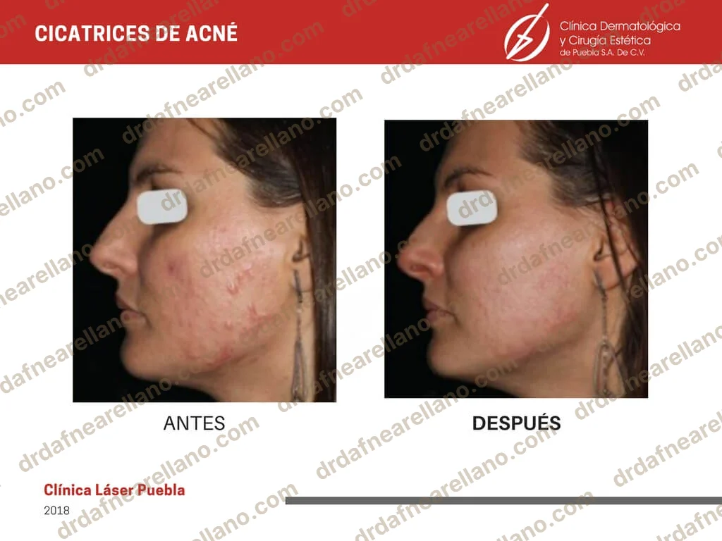 Antes y después — Tratamiento de Cicatrices de Acné en Puebla