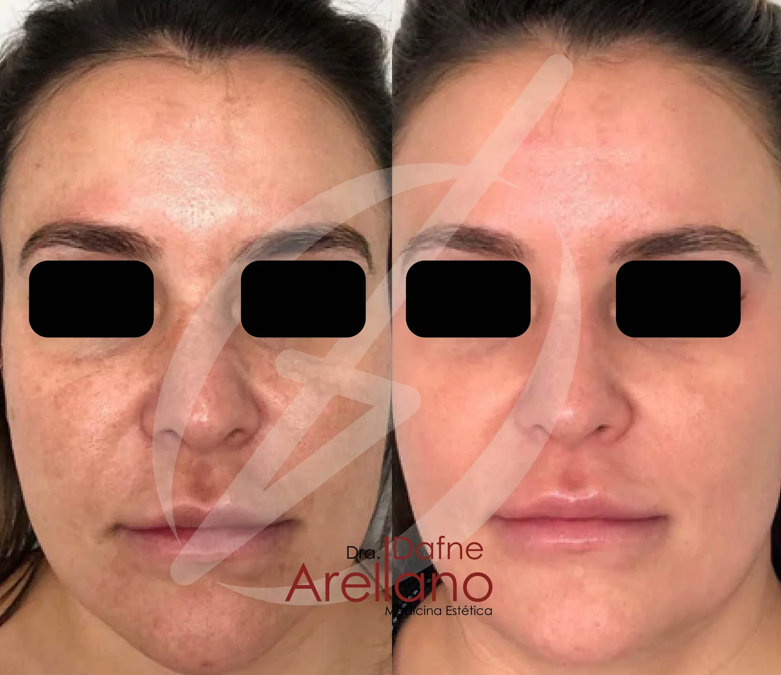 Antes — Cosmelan en Puebla – Despigmentación Profesional