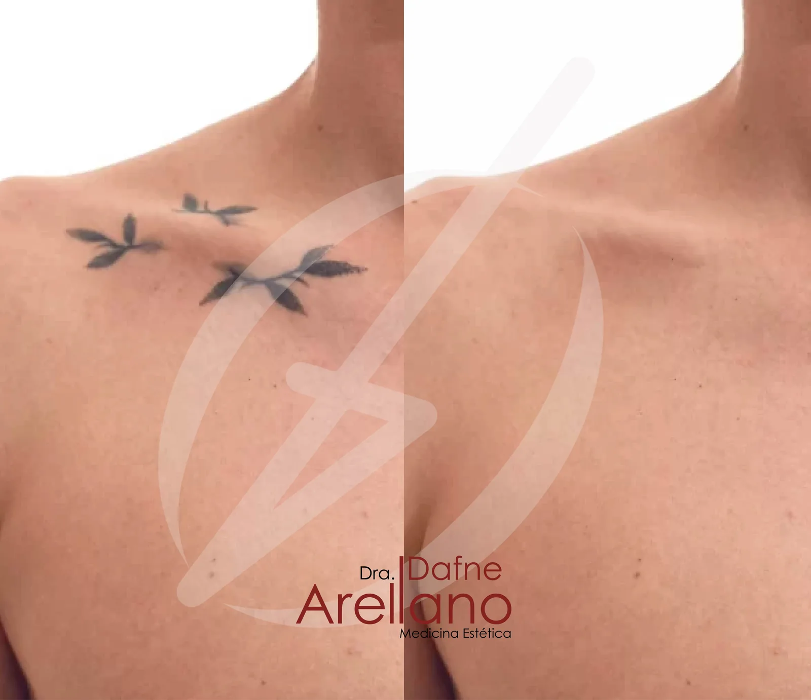 Antes y después · Eliminacion Tatuajes Laser