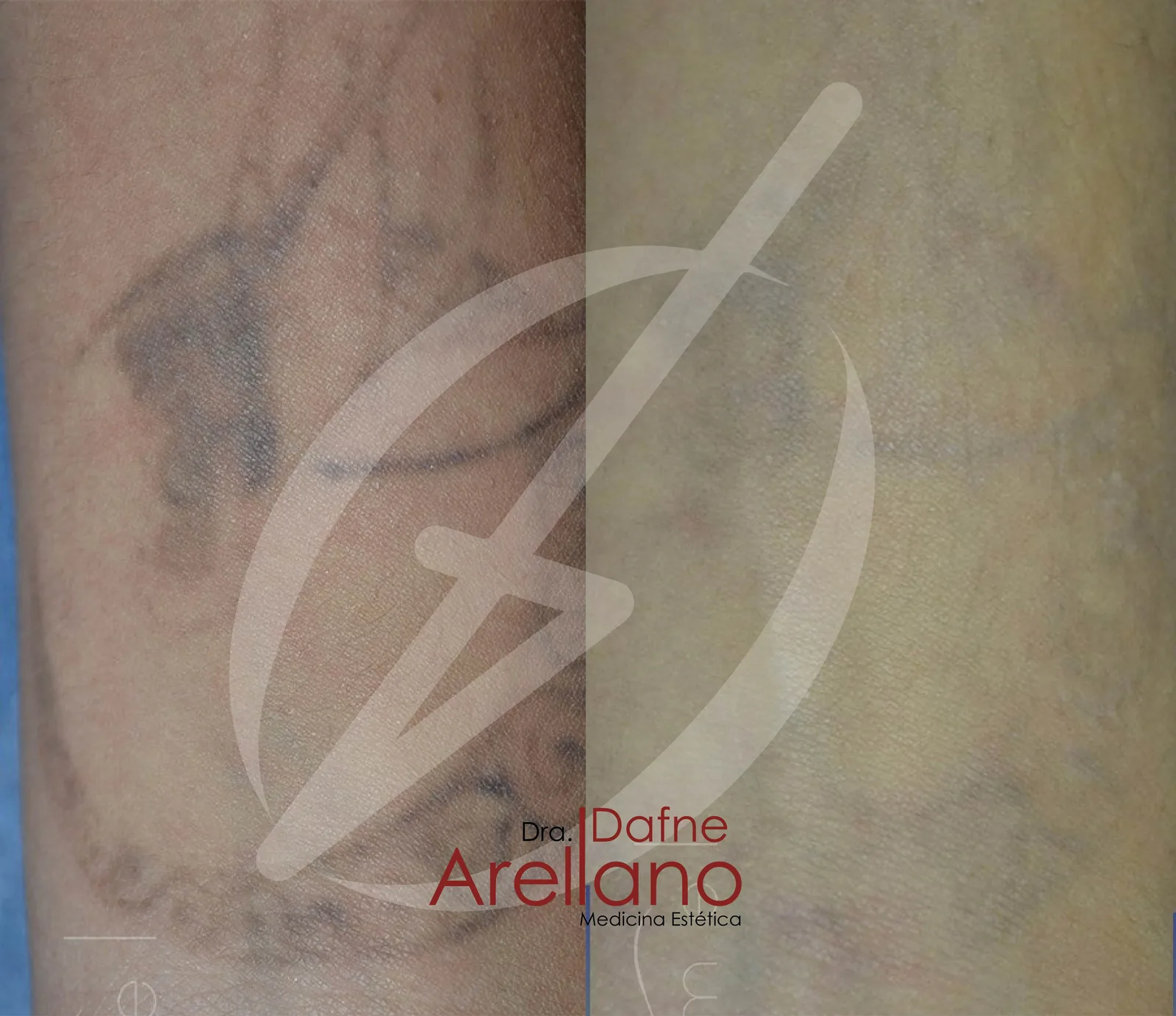 Antes y después · Eliminacion Tatuajes Laser