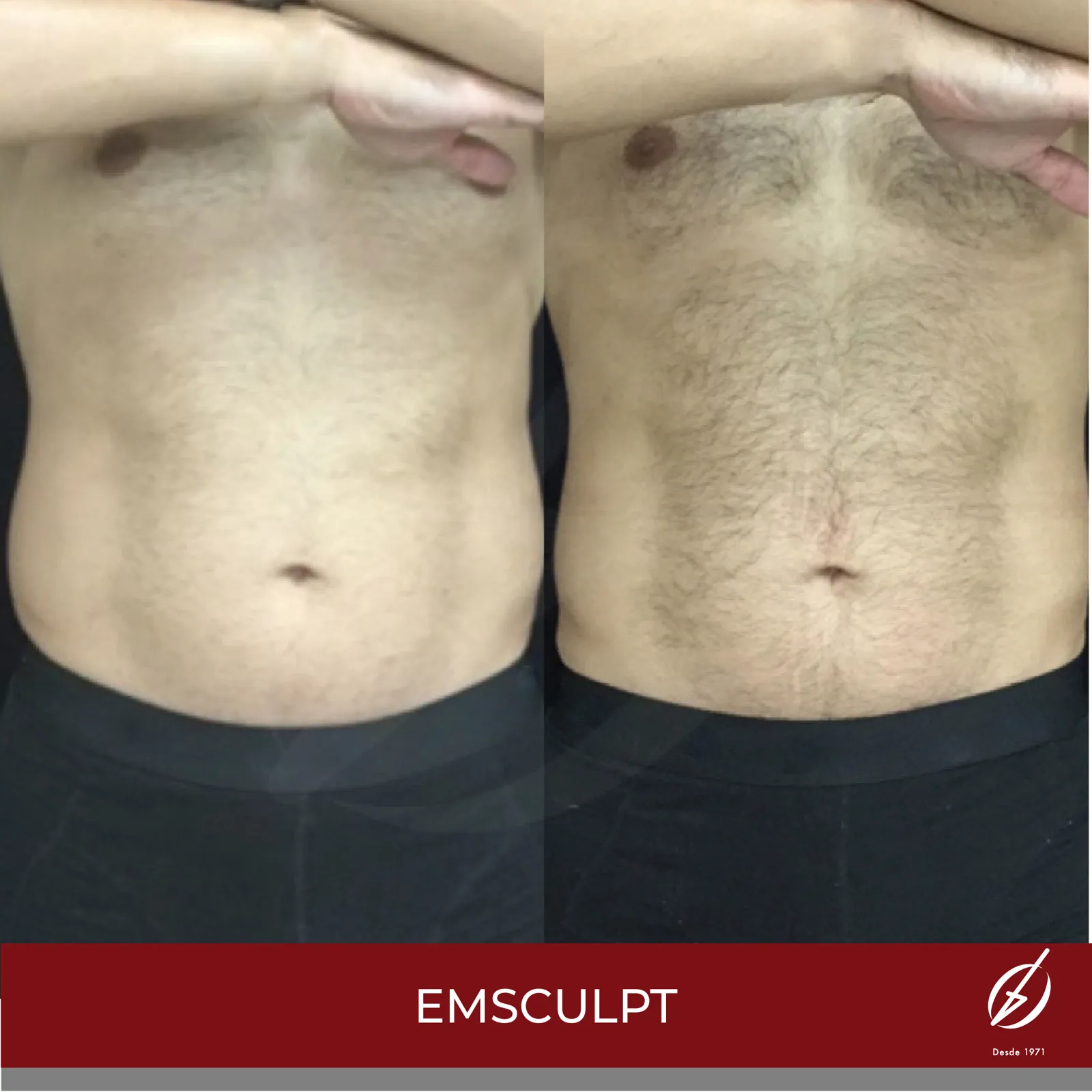 Emsculpt abdomen — resultado del protocolo completo (imagen combinada antes/después)