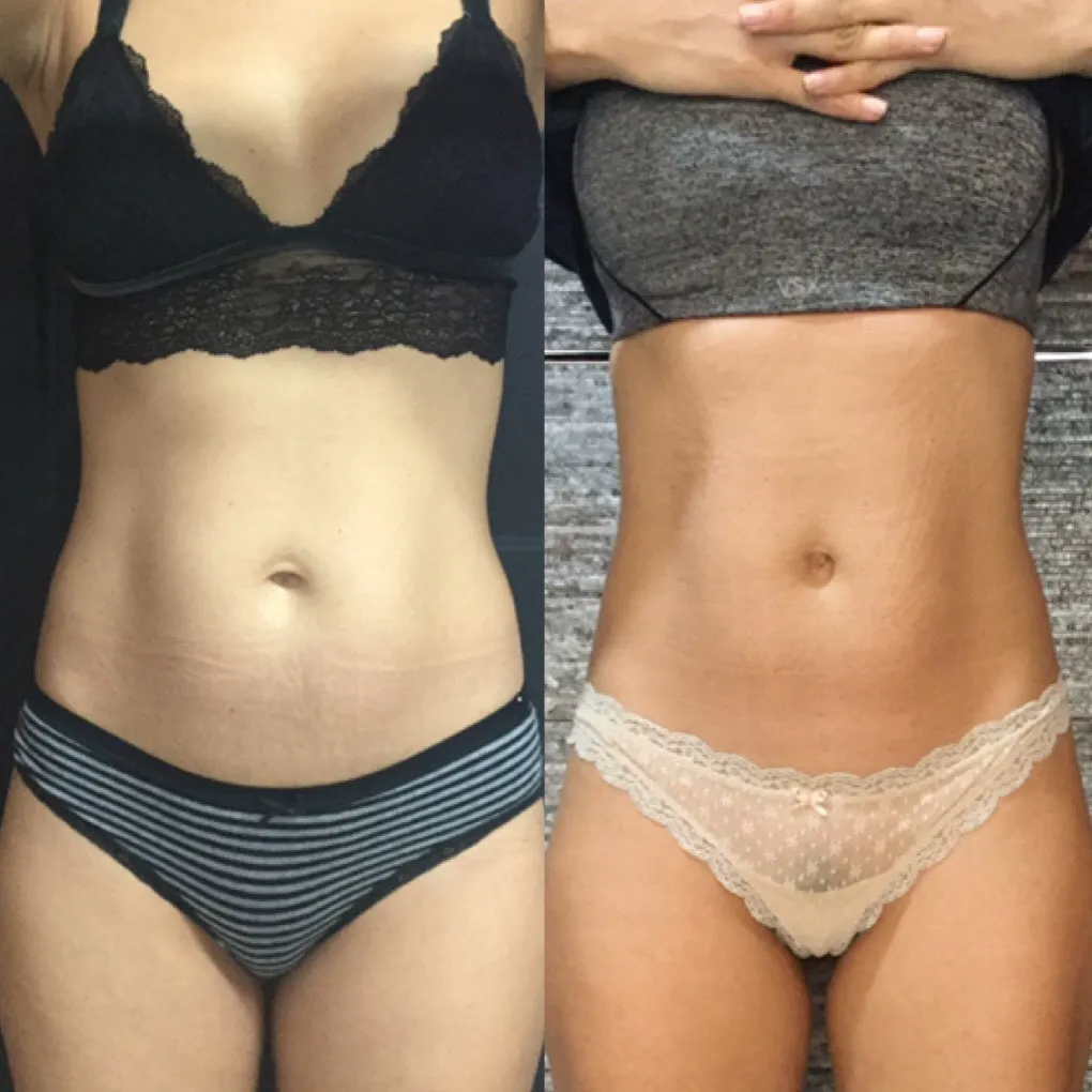 Emsculpt abdomen vista frontal — antes y después del protocolo