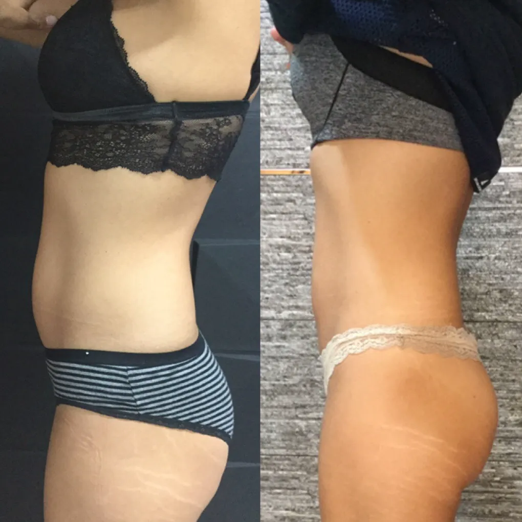 Emsculpt abdomen y glúteo vista lateral — antes y después