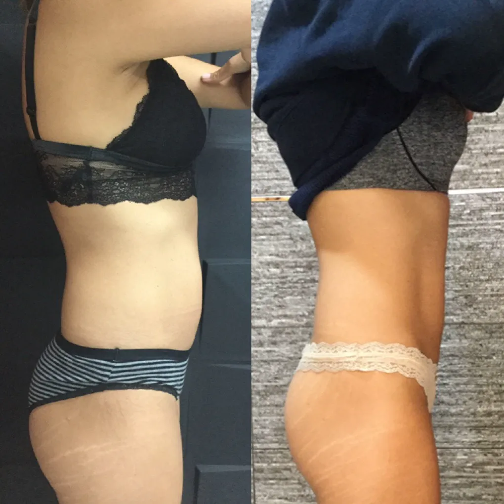 Emsculpt vista lateral — reducción de grasa y tono muscular antes/después