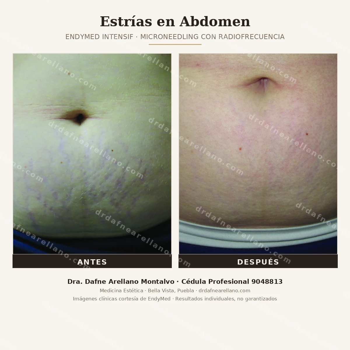 Estrias en abdomen tratadas con EndyMed Intensif (microneedling con radiofrecuencia) — antes y despues. Mejora de textura y profundidad de las estrias. Dra. Dafne Arellano Montalvo, Puebla.