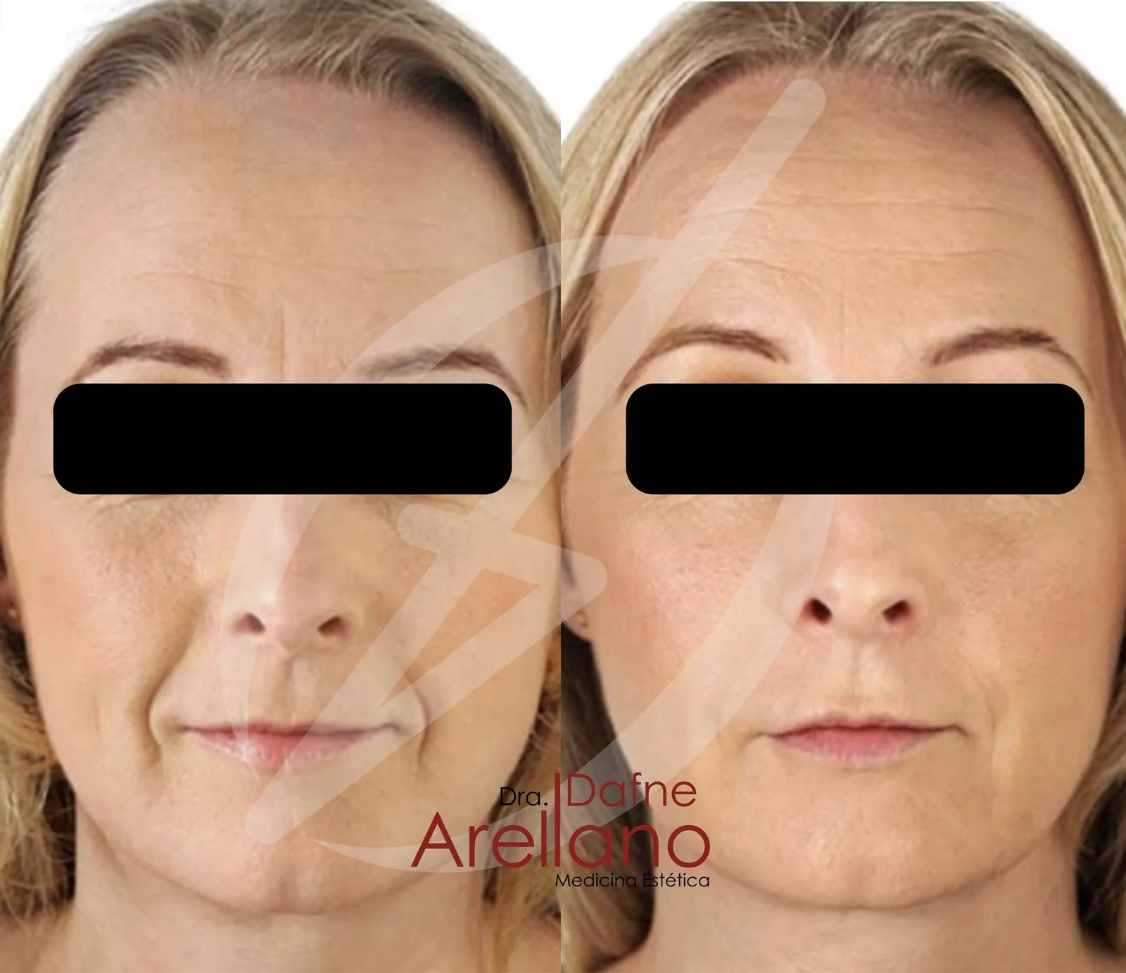 Antes y después · Exosomas