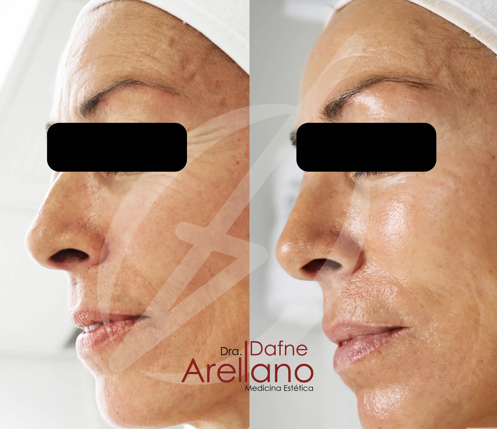 Antes y después · Facial Deluxe Casmara
