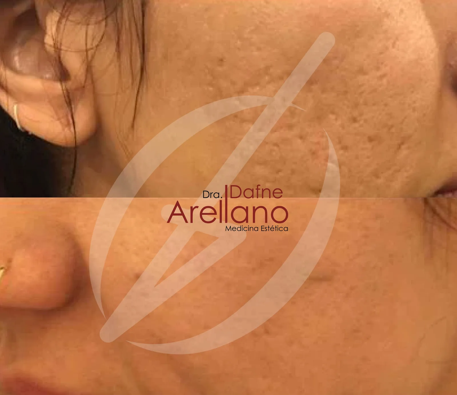 Después — Facial Enzimático PBSerum en Puebla