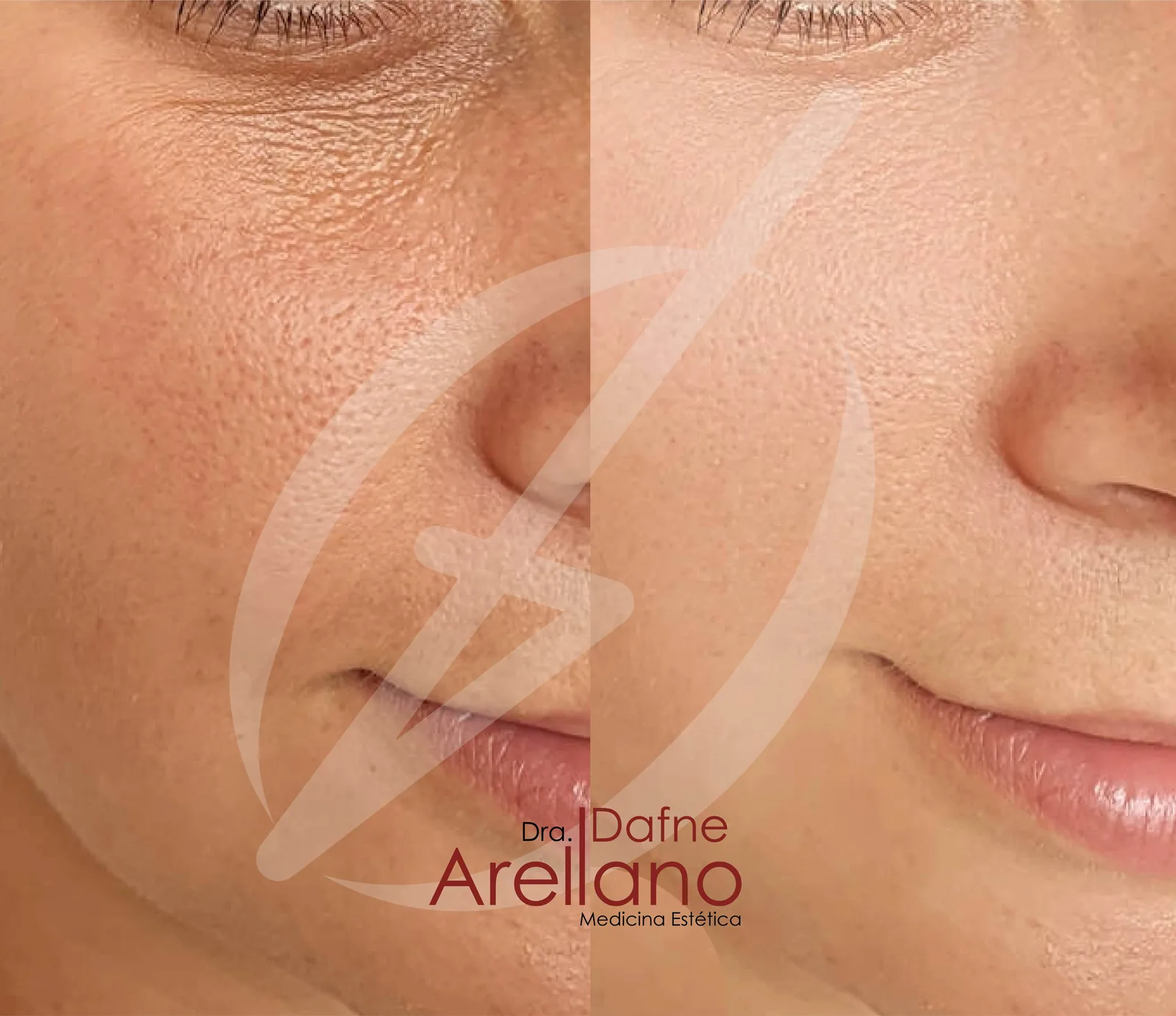 Antes — Facial Enzimático PBSerum en Puebla