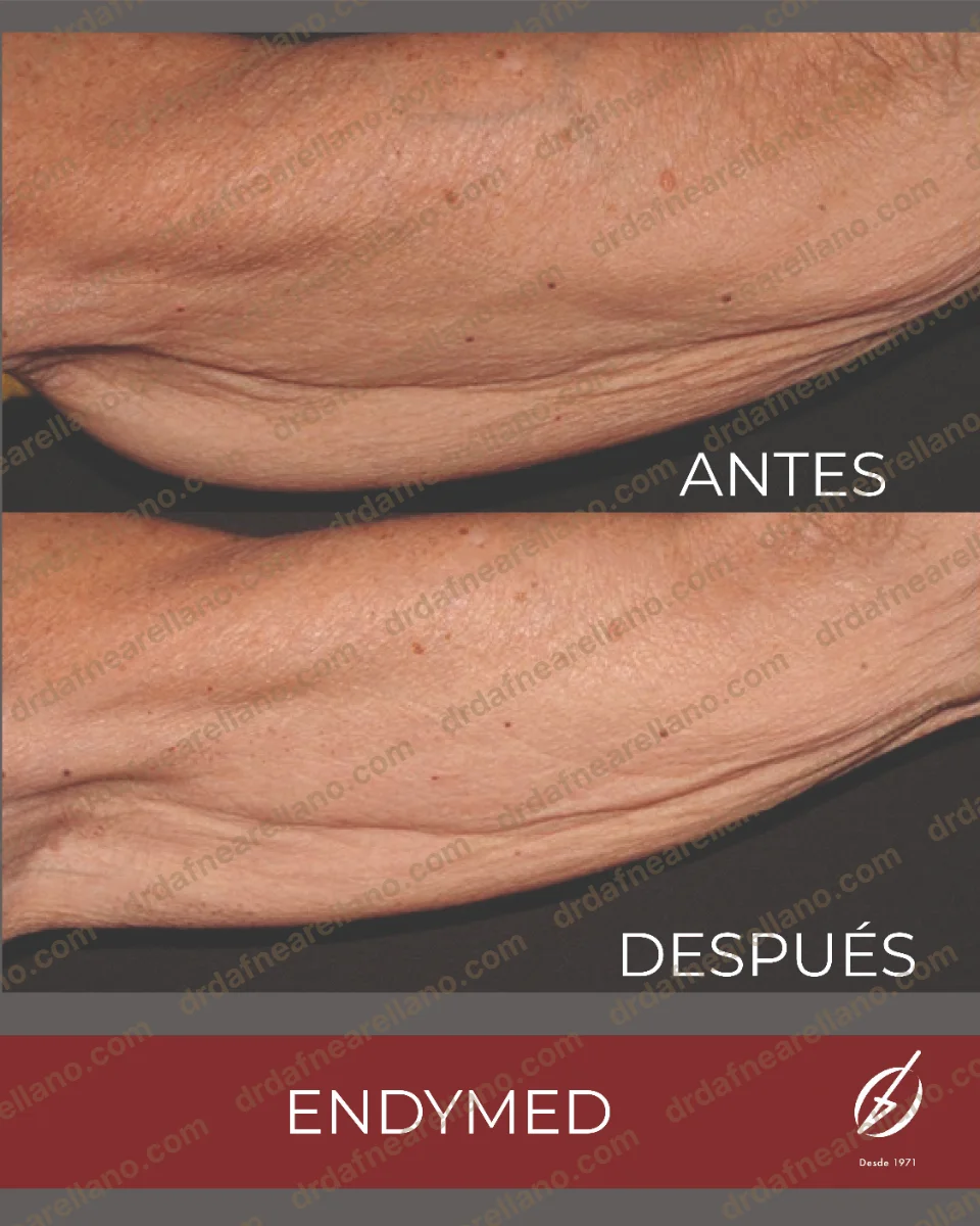 Antes y después — Flacidez Corporal en Puebla