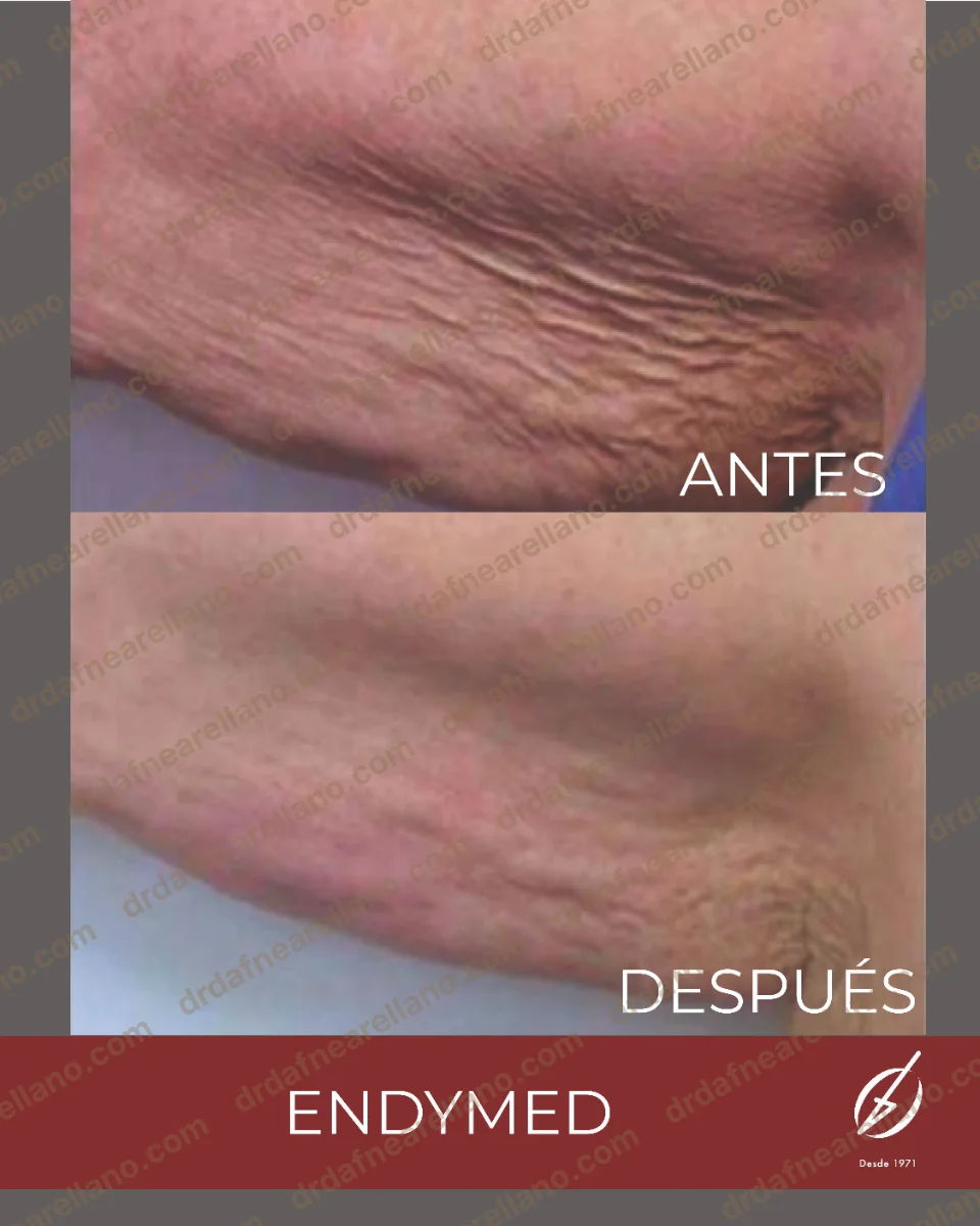 Antes y después — Flacidez Corporal en Puebla