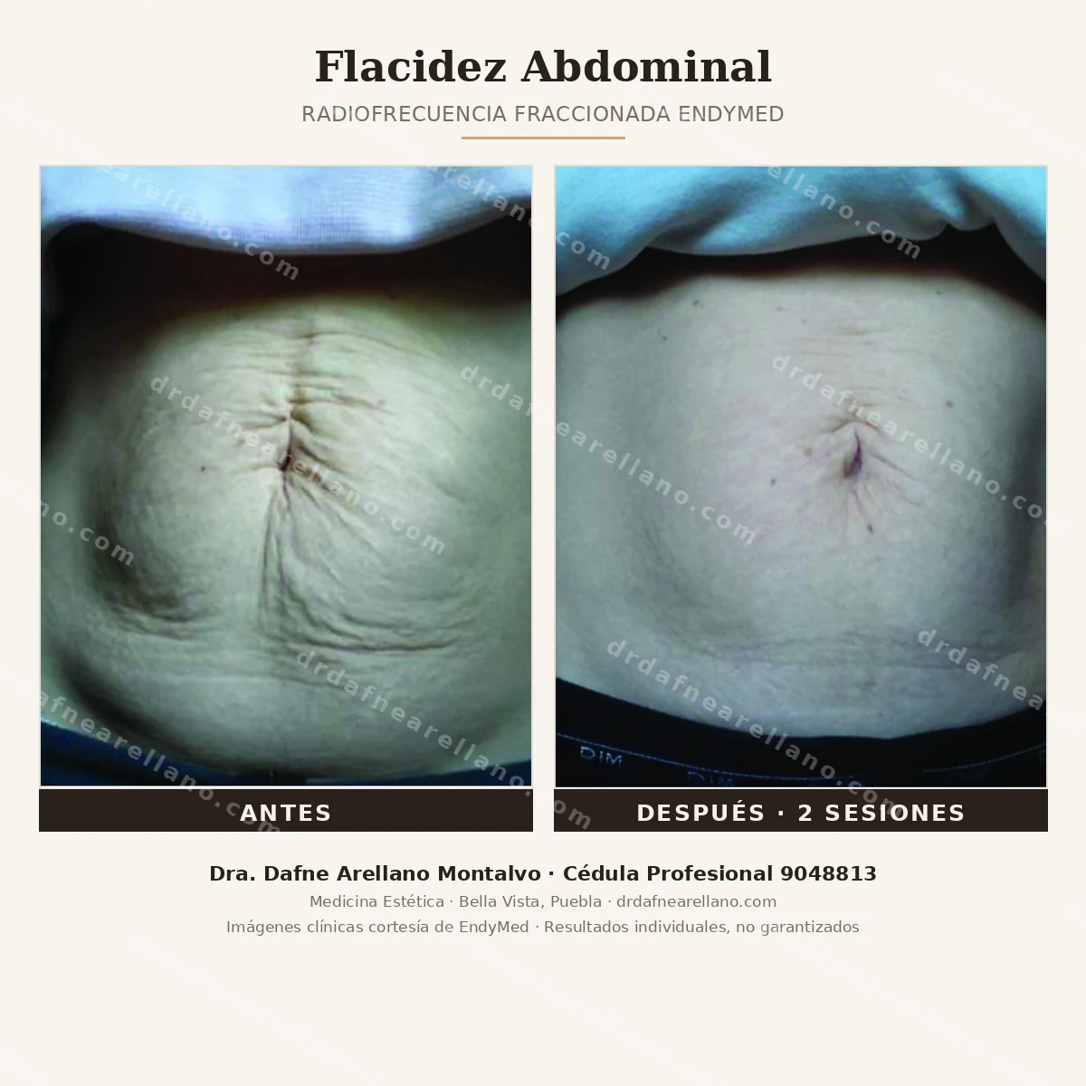 Flacidez abdominal tratada con radiofrecuencia fraccionada EndyMed — antes y despues de 2 sesiones. Piel del abdomen mas firme y con mejor textura. Dra. Dafne Arellano Montalvo, Cedula Profesional 9048813, Bella Vista, Puebla.