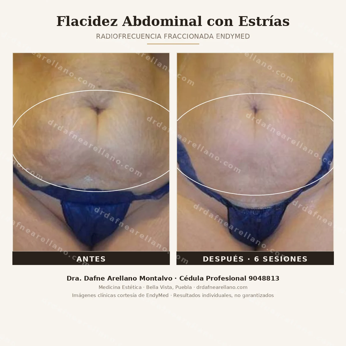 Flacidez abdominal con estrias — patron frecuente despues del embarazo — tratada con radiofrecuencia fraccionada EndyMed. Antes y despues de 6 sesiones. Dra. Dafne Arellano Montalvo, Puebla.