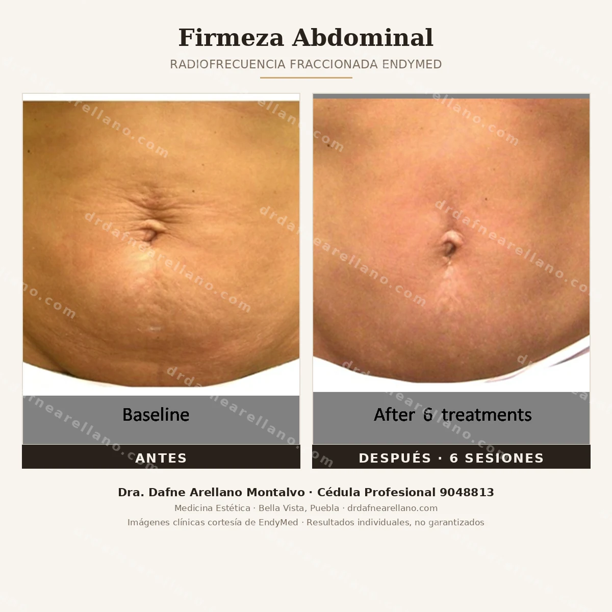 Firmeza abdominal con radiofrecuencia fraccionada EndyMed — antes y despues de 6 sesiones. Tensado de la piel del abdomen sin cirugia. Dra. Dafne Arellano Montalvo, Puebla.