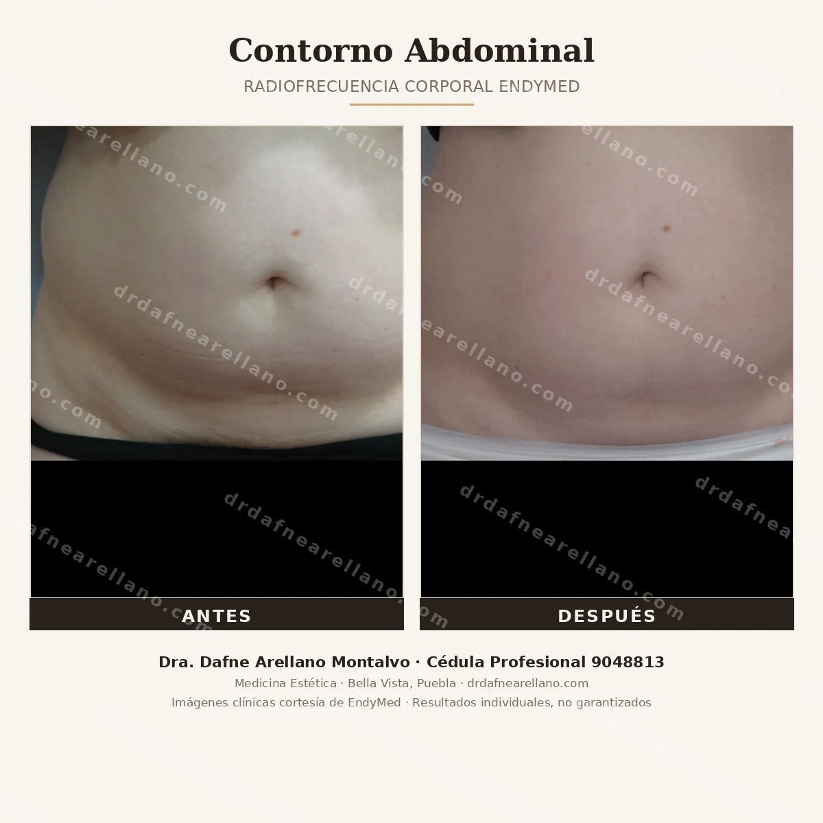 Contorno abdominal con radiofrecuencia corporal EndyMed — antes y despues. Reduccion de flacidez y mejora del contorno. Dra. Dafne Arellano Montalvo, Bella Vista, Puebla.