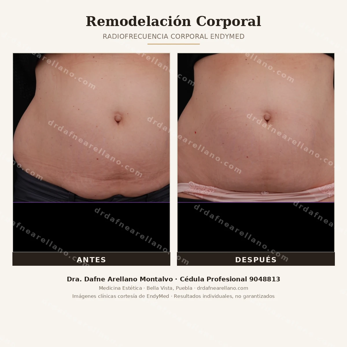 Remodelacion corporal con radiofrecuencia EndyMed — antes y despues. Mejora de firmeza y contorno abdominal. Dra. Dafne Arellano Montalvo, Puebla.