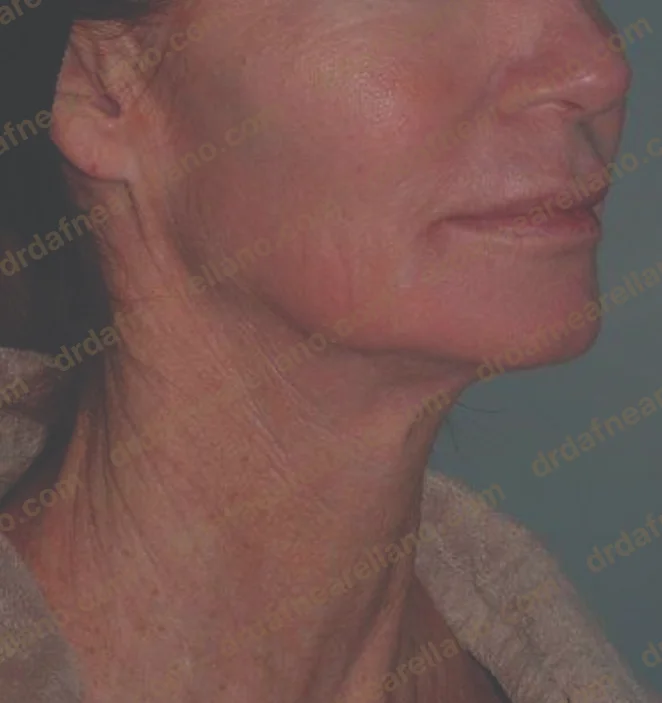 Después — Tratamiento de Flacidez Facial en Puebla