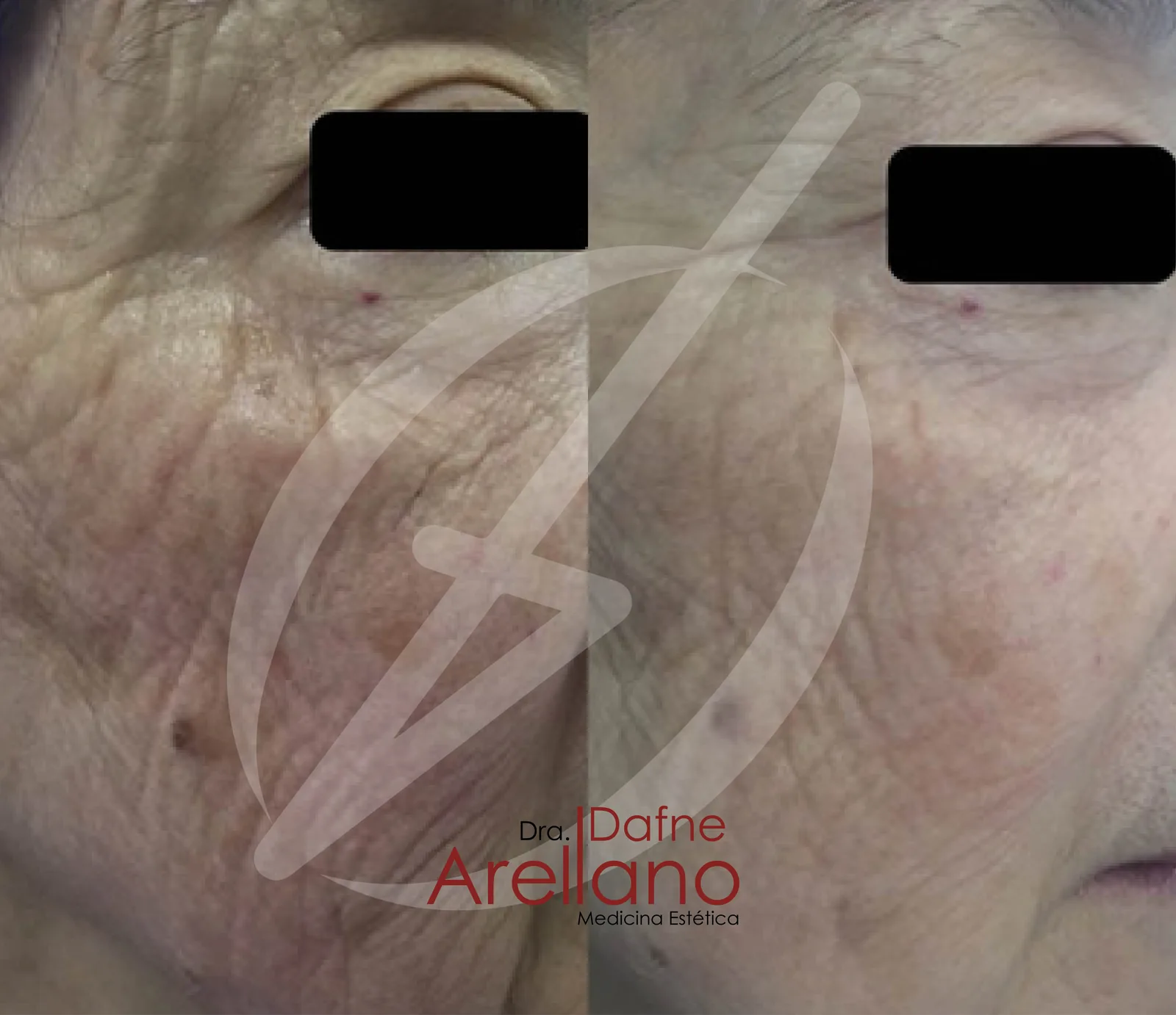 Después — Tratamiento de Flacidez Facial en Puebla